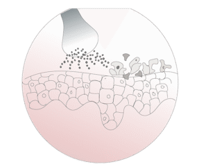 dermabrasio